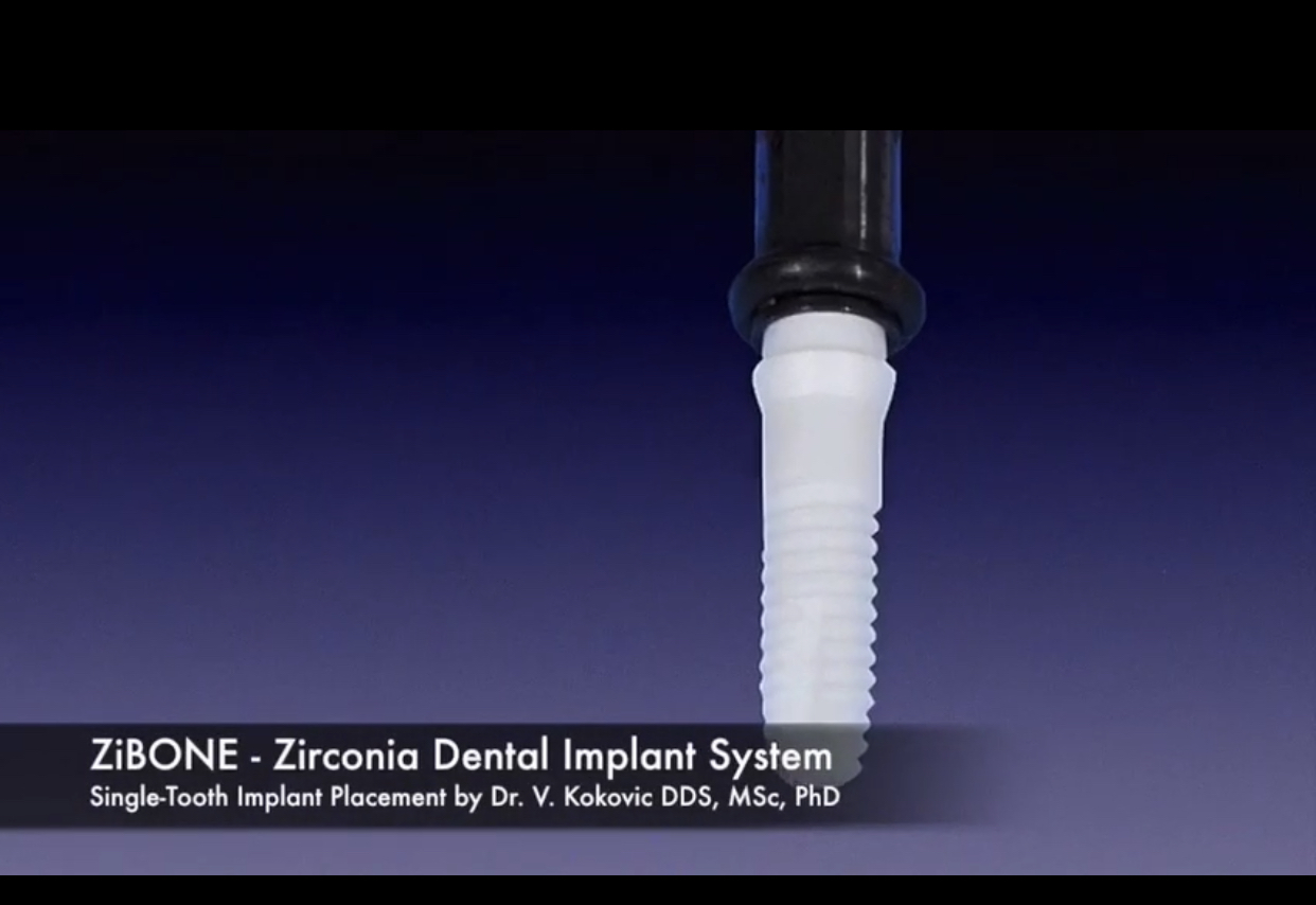 Zibone-Zirconia Dental Implant System Dubai