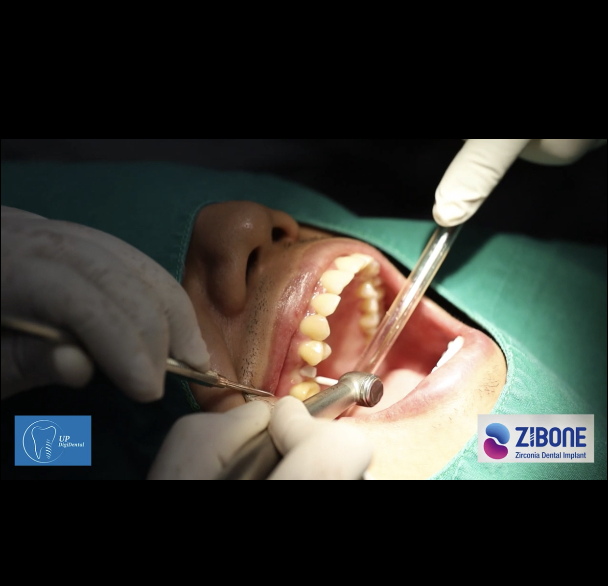 Zibone-Zirconia Dental Implant System -Thailand